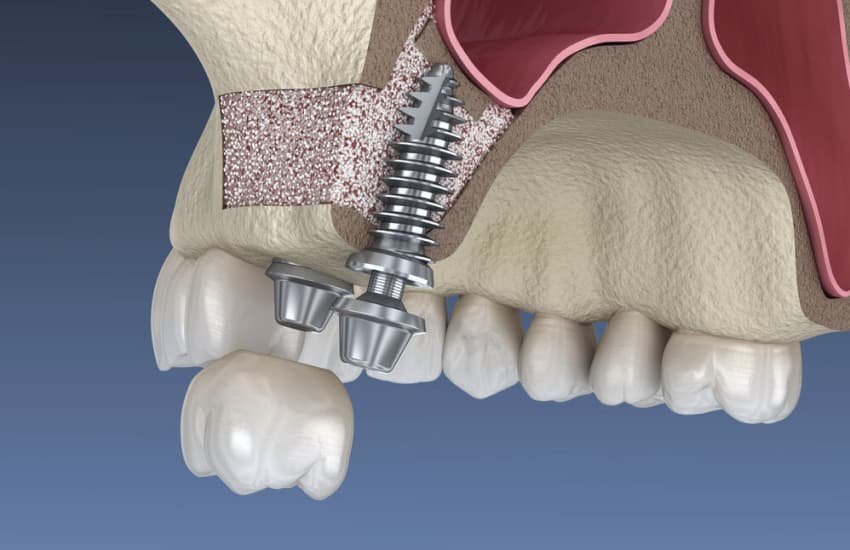 Frenectomy in Philmont, NY - Philmont Family Dentistry