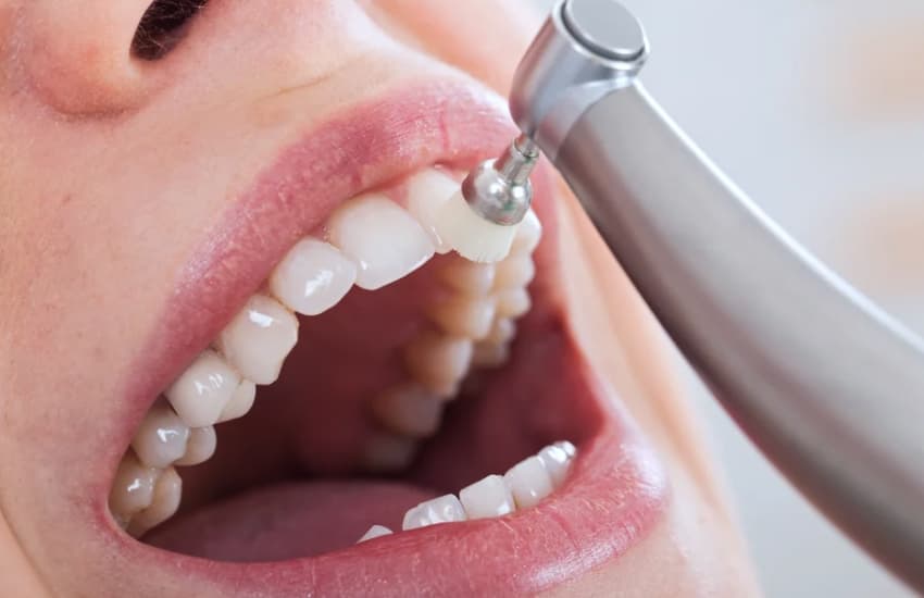 Fluoride Treatments in Philmont, NY - Philmont Family Dentistry