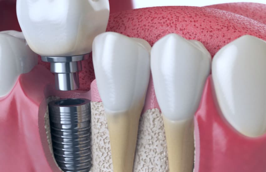 Bone Grafting in Philmont, NY - Philmont Family Dentistry