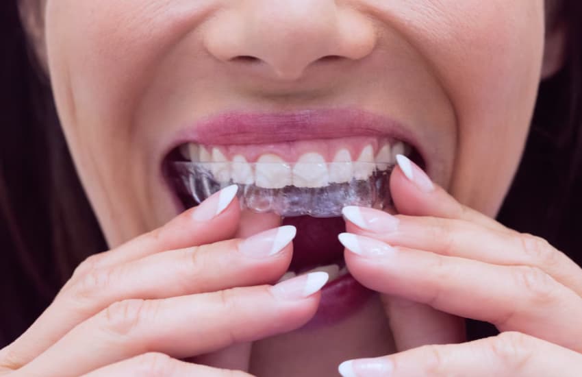 Clear Aligners (Invisalign) in Philmont, NY - Philmont Family Dentistry