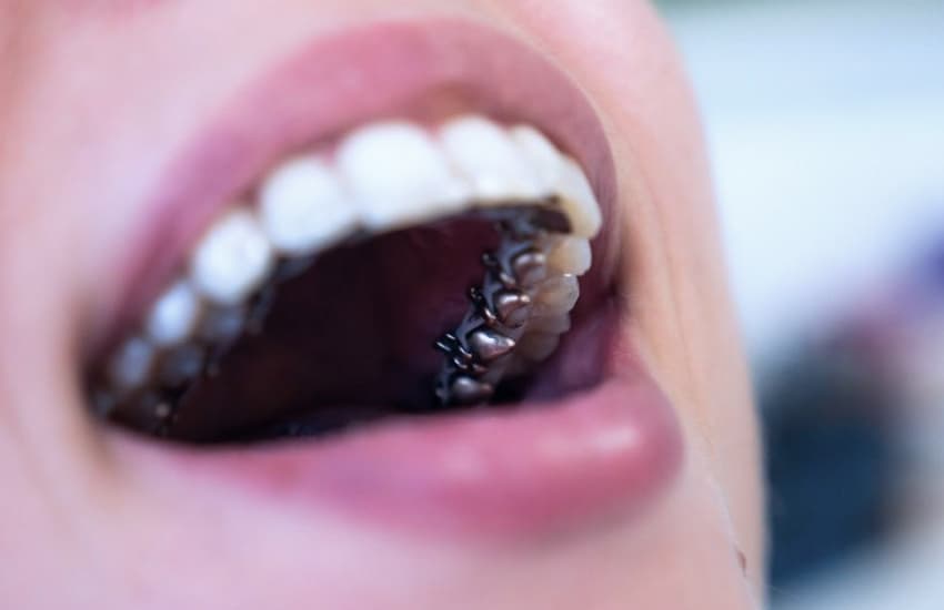 Lingual Braces in Philmont, NY - Philmont Family Dentistry