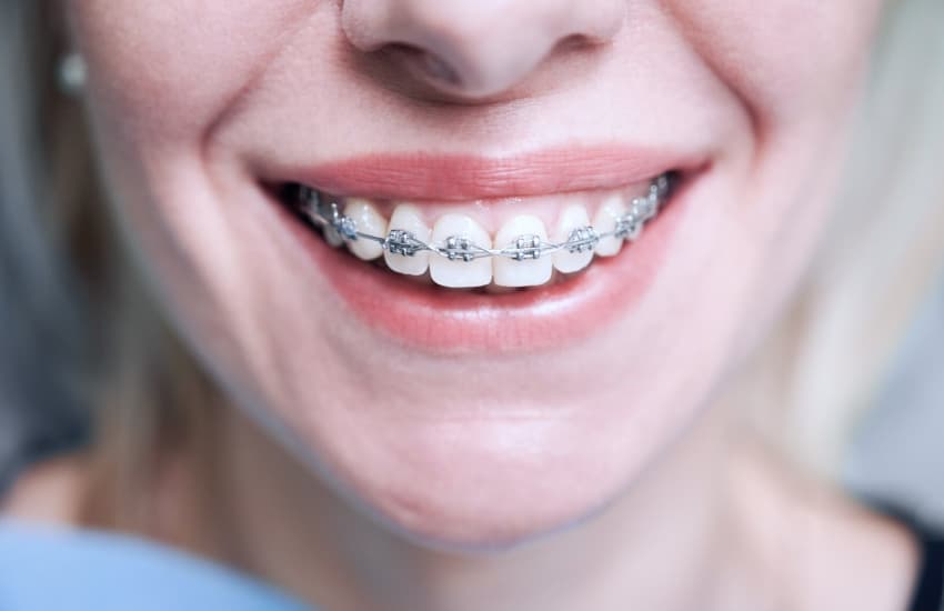 Ceramic Braces in Philmont, NY - Philmont Family Dentistry