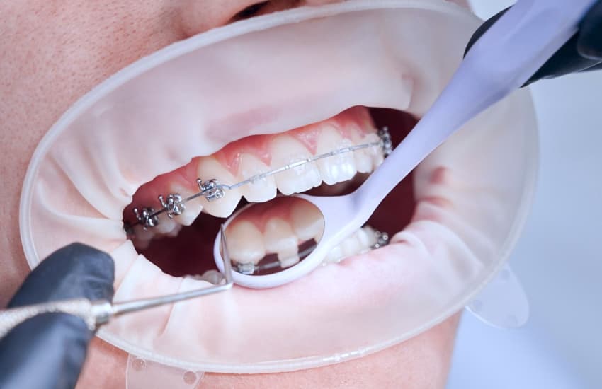 Traditional Metal Braces in Philmont, NY - Philmont Family Dentistry